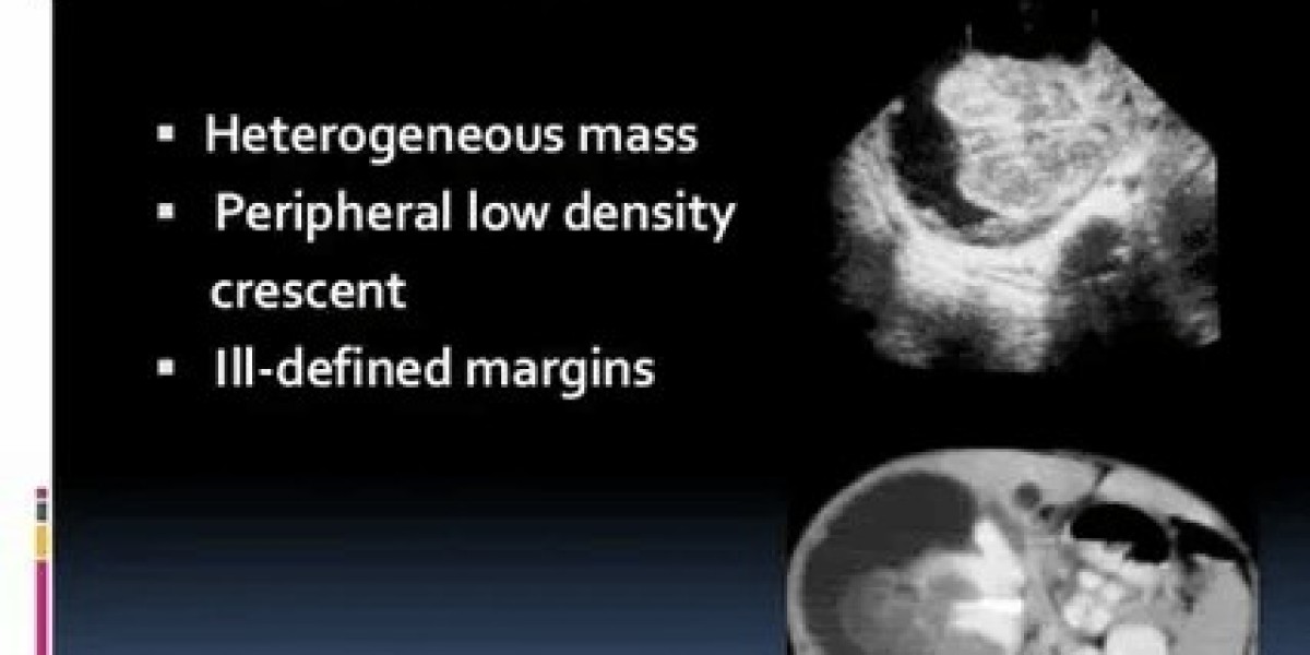 Rhabdoid Tumor Treatment Market Size & Growth Outlook