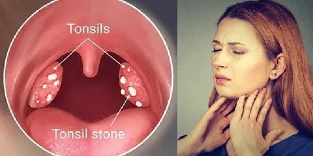 Tonsillitis Drugs Market Size, Share & Prescription Trends Analysis