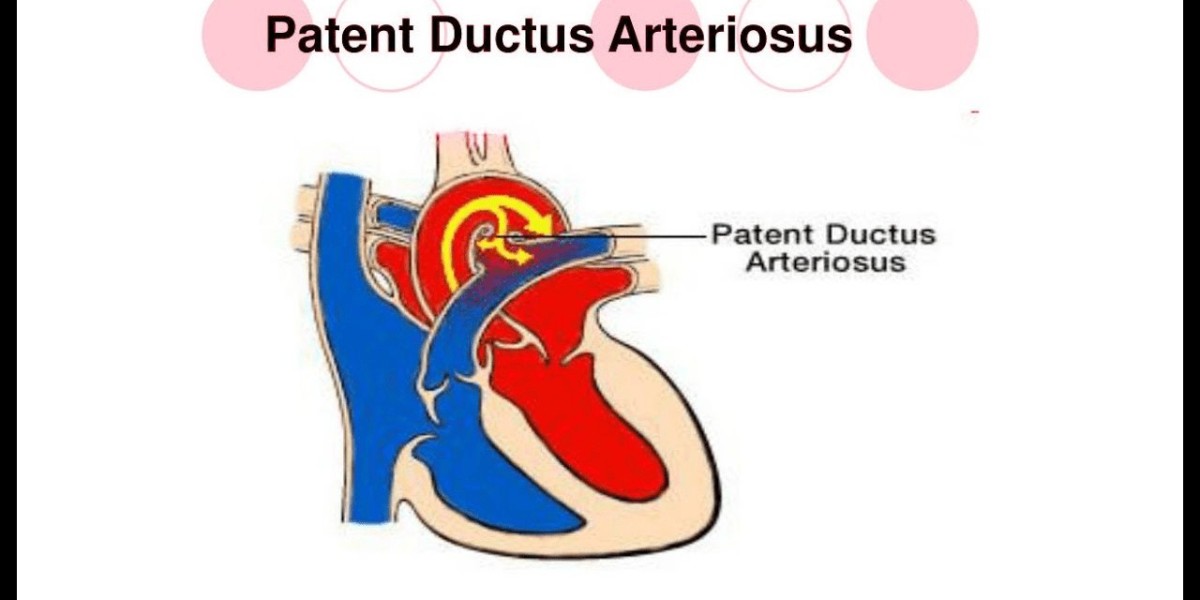 Global Patent Ductus Arteriosus Treatment Market Overview