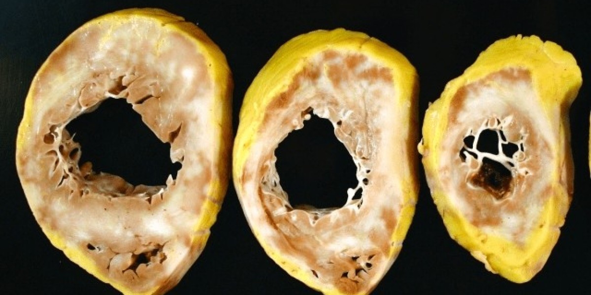 Danon Disease Treatment Market Addressing Rare Disease Needs