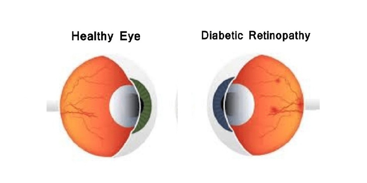 Global Diabetic Retinopathy Market Overview