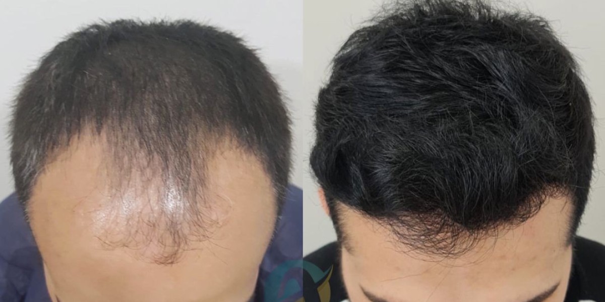 Hair Transplant in Islamabad: Your Guide to Permanent Hair Restoration
