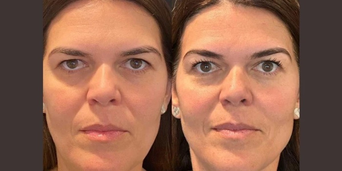 Thread Lift Safety Standards by Best Plastic Surgeons in Dubai