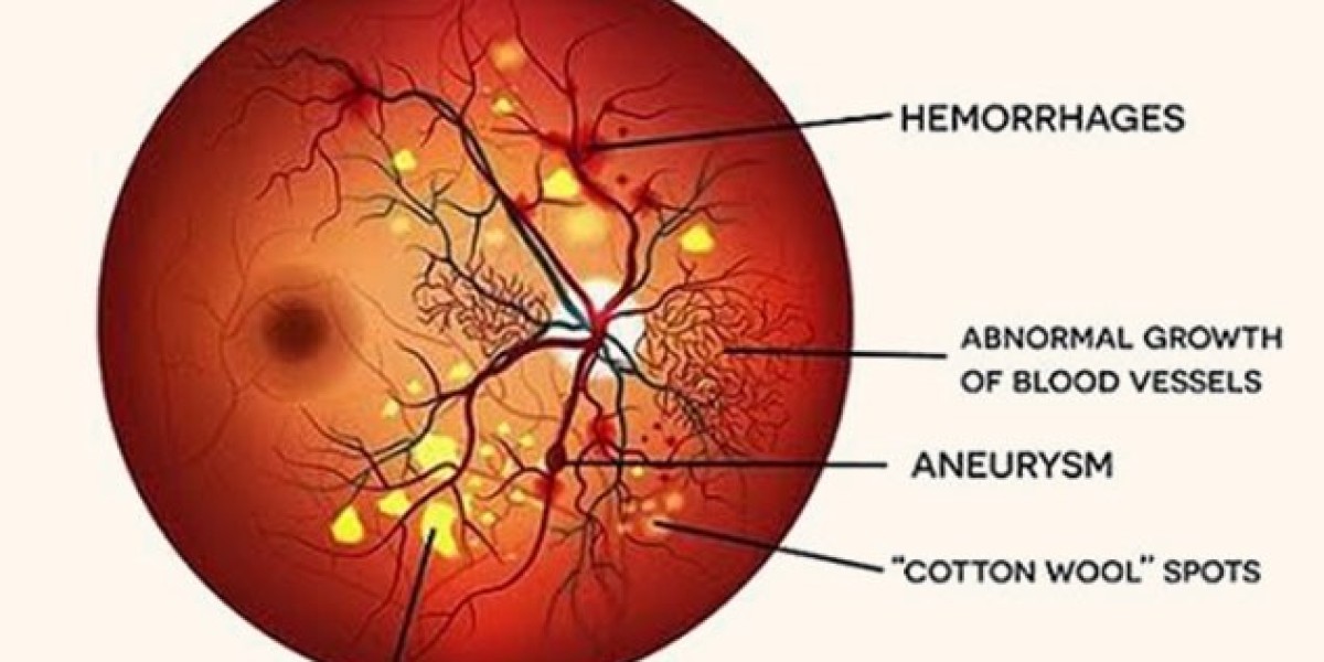 Saving Sight: The Battle Against Diabetic Retinopathy
