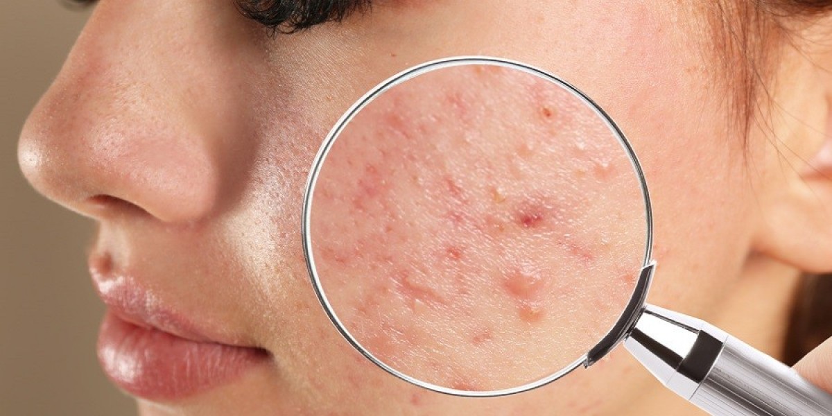 Step-by-Step Process of Acne Treatment in Riyadh