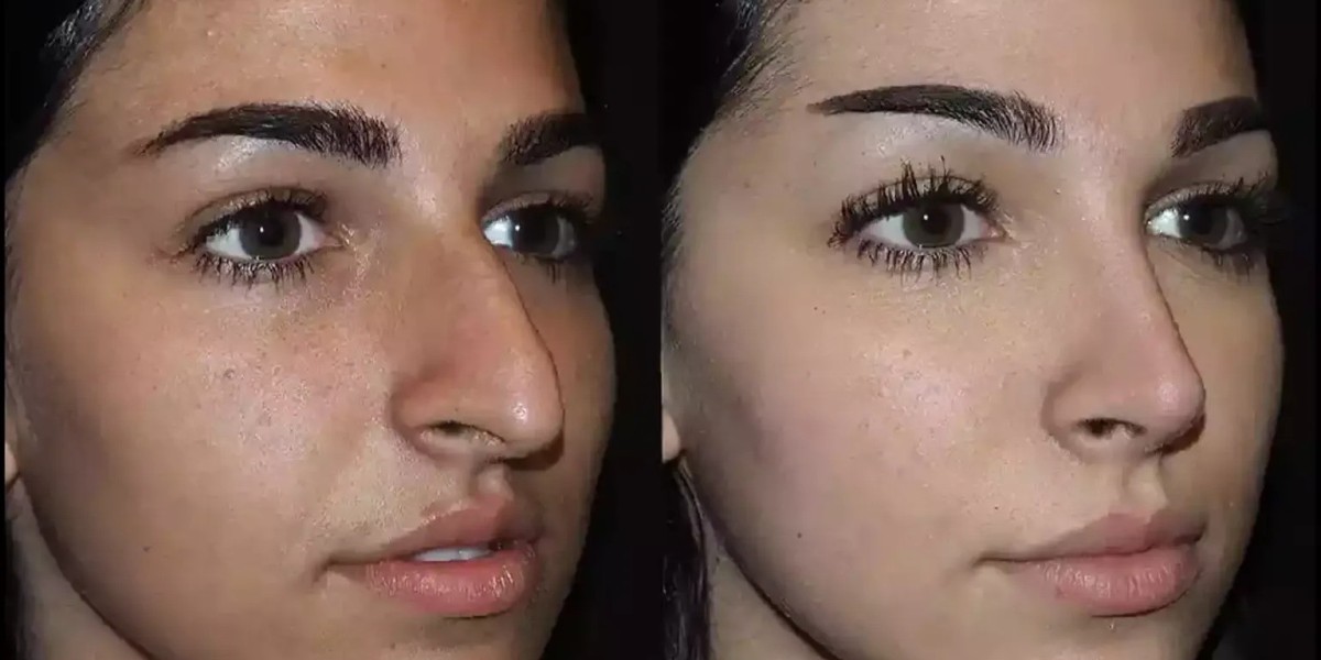 Septoplasty in Dubai: Functional Results Over Time