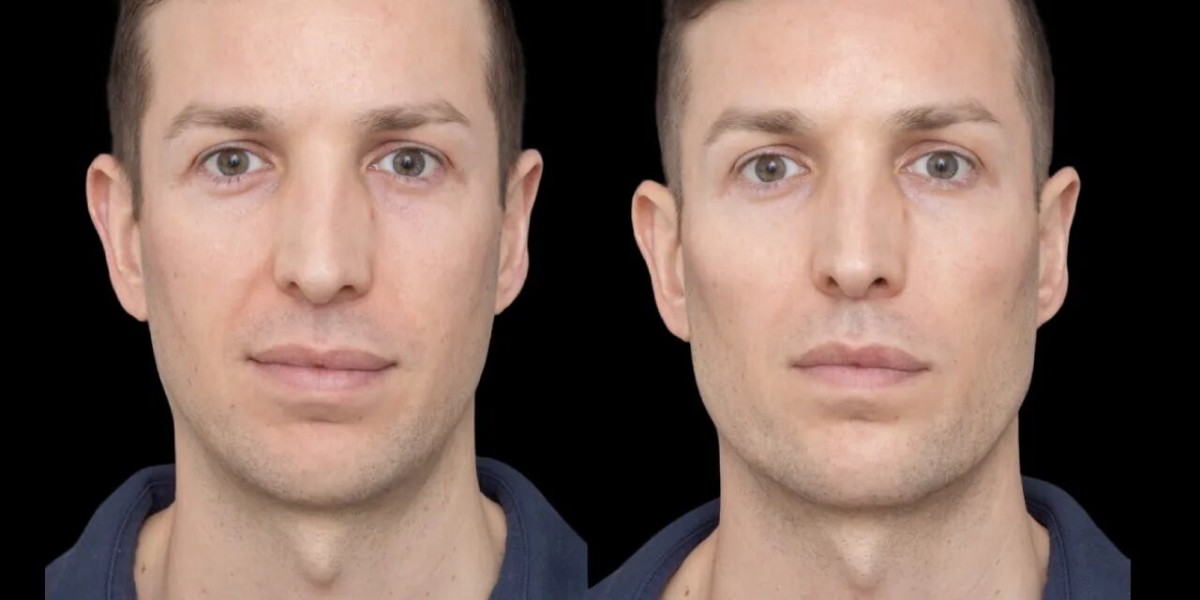 Best Aesthetic Clinics in Dubai for Modern Cheek Fillers Treatments