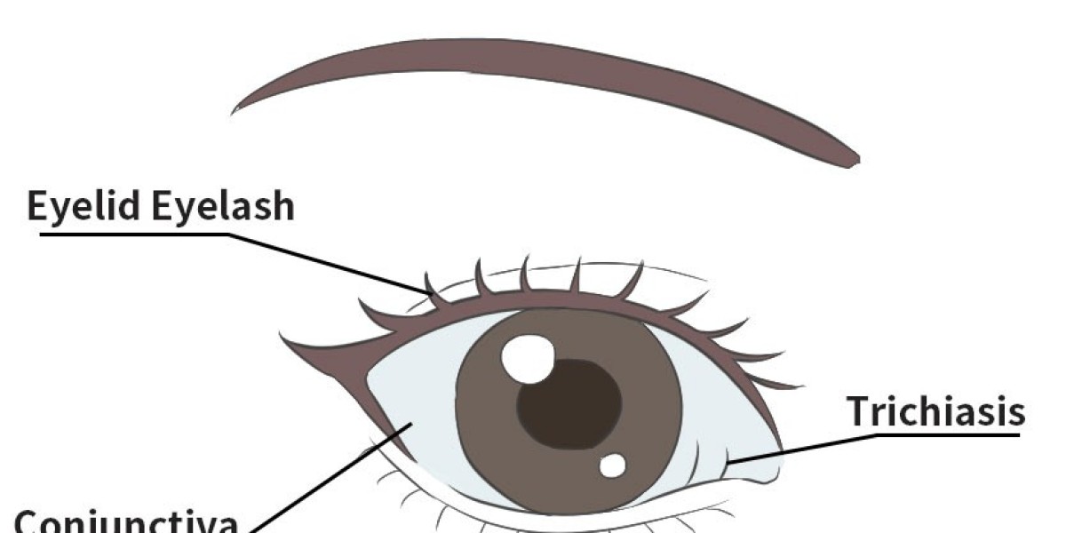 Beyond the Lash: The Future of Trichiasis Surgical Interventions