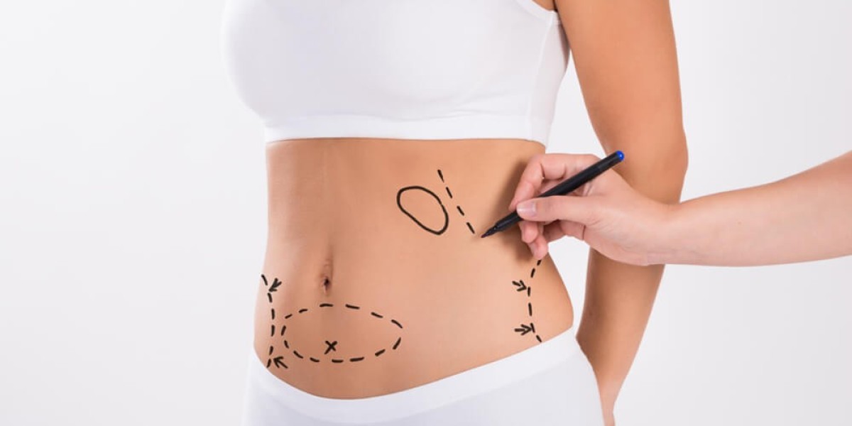 Discover the Power of Liposuction Surgery in Dubai