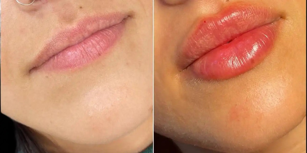 Best Aesthetic Clinics in Dubai Affordable Fillers Options