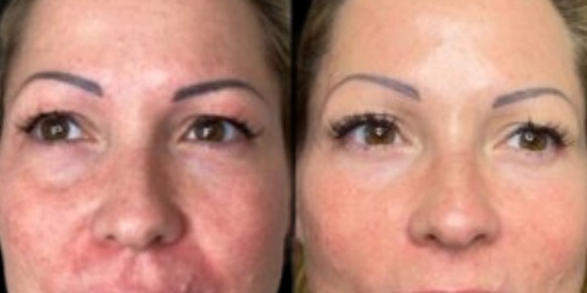 Best Plastic Surgeon in Dubai for Customized Profhilo Protocols