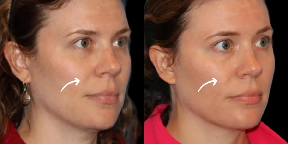 Best Plastic Surgeon in Dubai on Sculptra Injection Plan