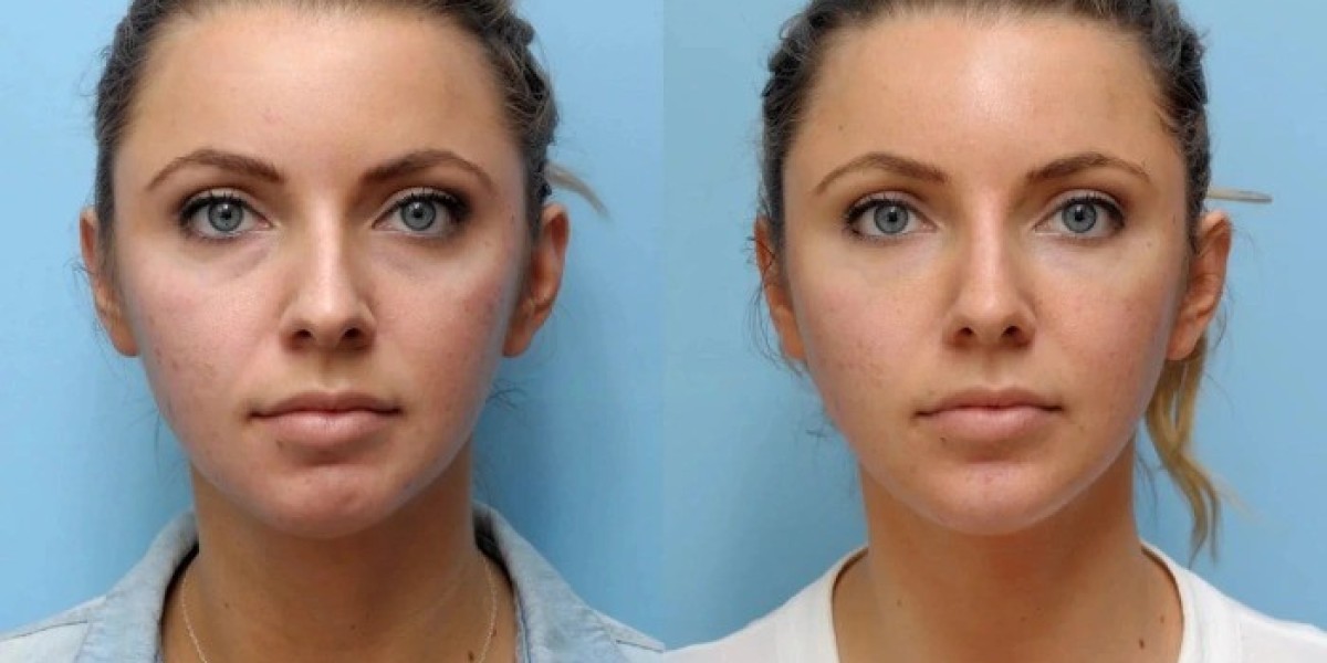 Trusted Best Facial Thread Lift Treatment in Dubai for Anti Aging