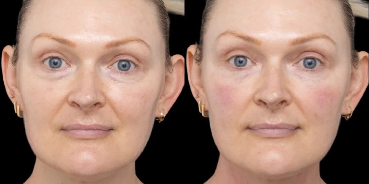 Best Aesthetic Clinics in Dubai for Advanced Under Eye Fillers Treatments