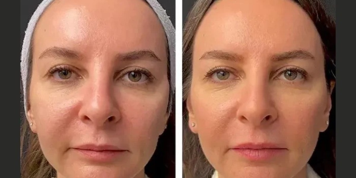 What to Expect During Your Mesotherapy Session with the Best Doctors in dubai