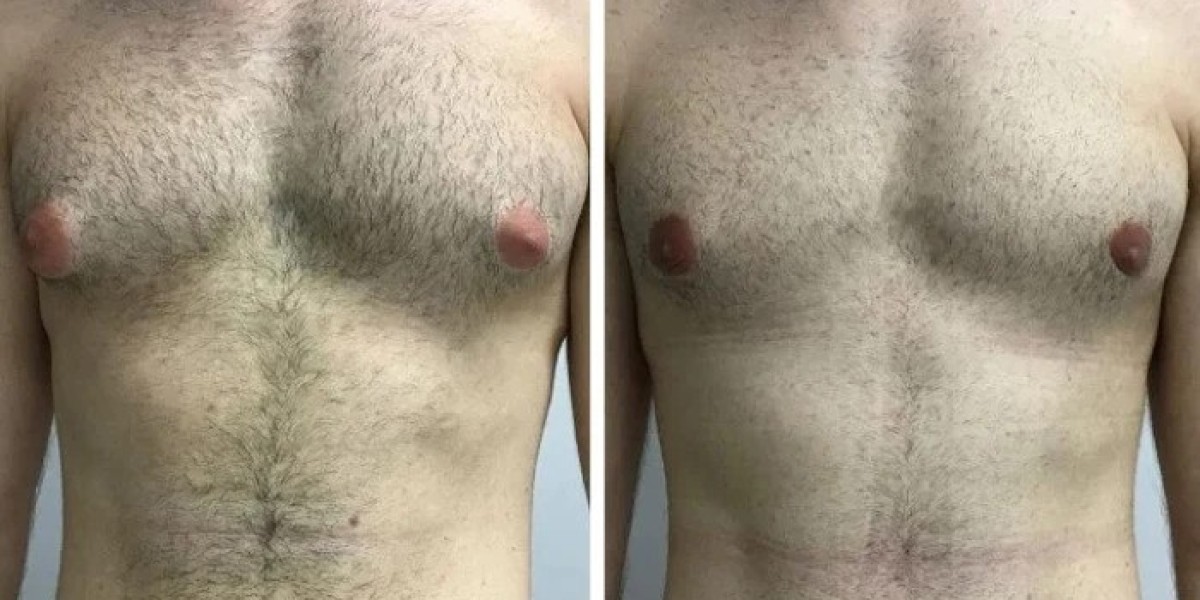 Understanding the Techniques Used by the Best Gynecomastia Surgeons in Dubai
