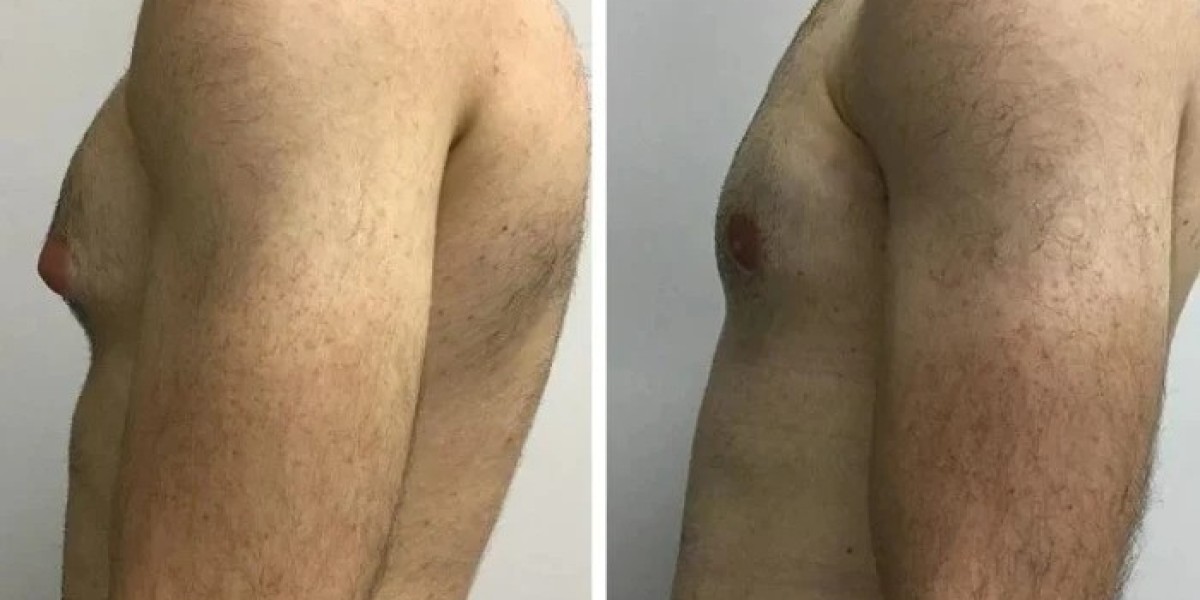Gynecomastia Surgery in Dubai: Restore a Masculine Silhouette