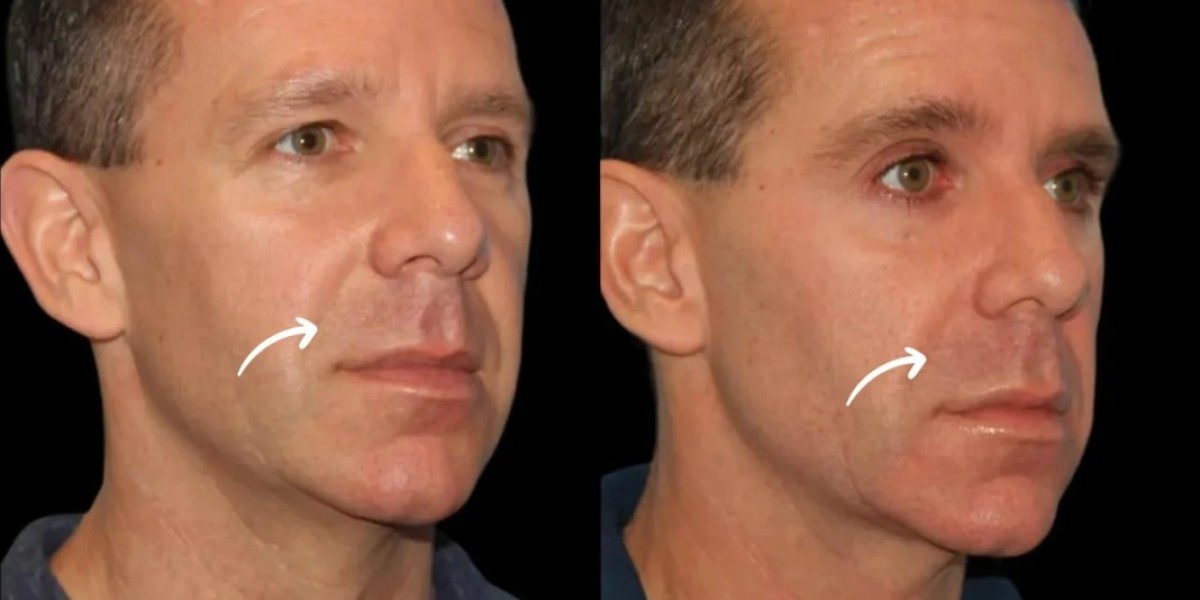 Sculptra Fillers Treatment in Dubai for Advanced Cosmetic Solutions
