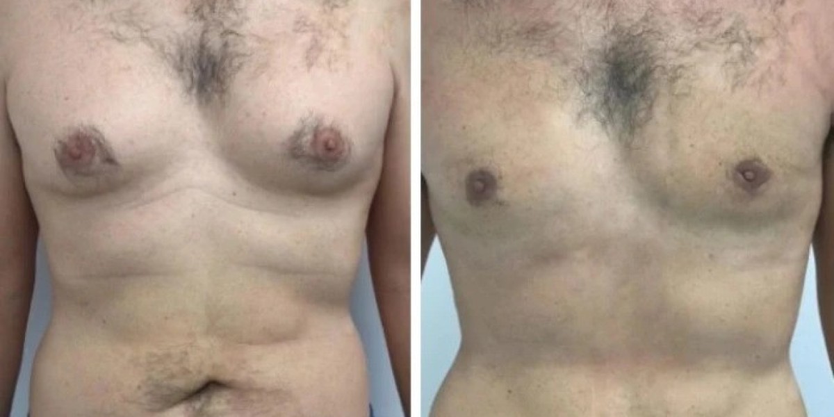 Best gynecomastia surgeons in Dubai for male chest sculpting results