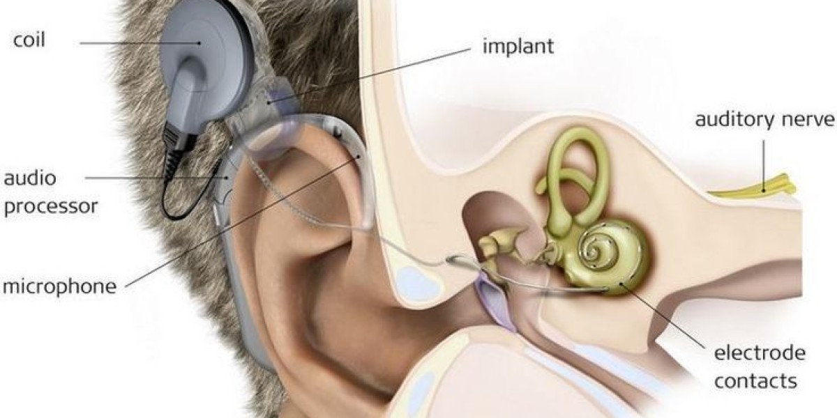 Latin America Cochlear Implants  Market Trends, Revenue Analysis and Industry Forecast Report