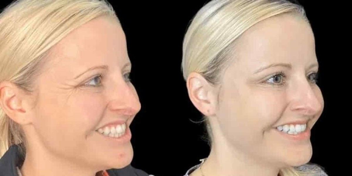 Best Plastic Surgeon in Dubai for Botox for Smooth and Youthful Skin