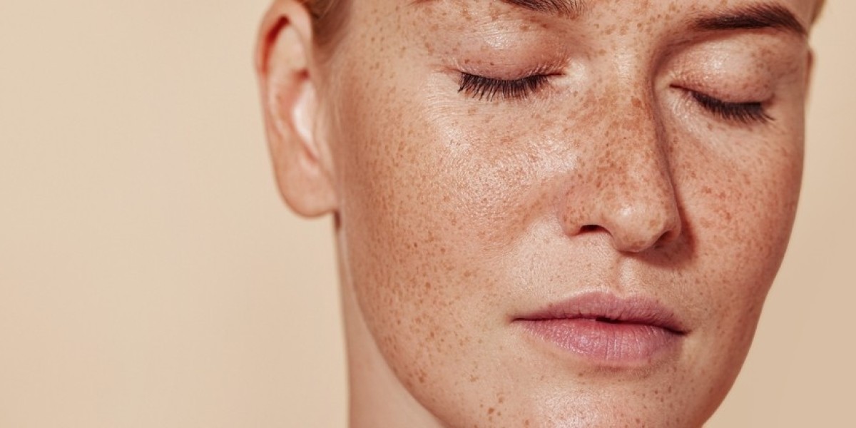 Pigmentation Treatment in Dubai: Best Non-Invasive Options