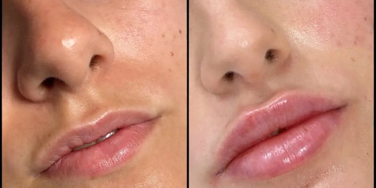 Best Plastic Surgeon in Dubai for Dermal Fillers: The Art of Facial Sculpting