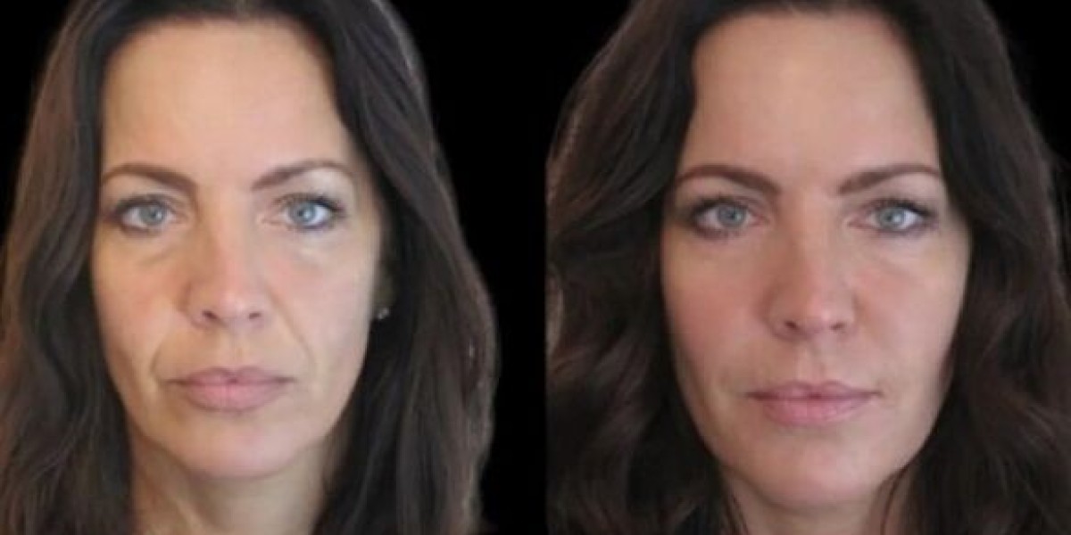 The Science Behind Jawline Fillers in Dubai and Their Effectiveness