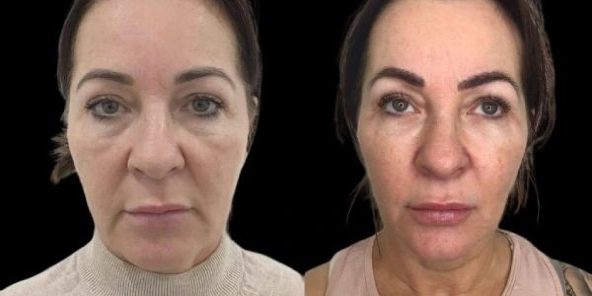 Do Best Aesthetic Clinics in Dubai Offer Profhilo Consultations?