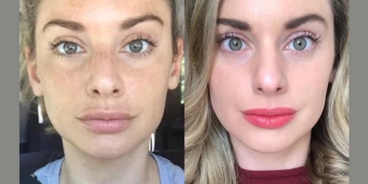 Radiofrequency (RF) Microneedling in Dubai: The Ultimate Anti-Aging Solution