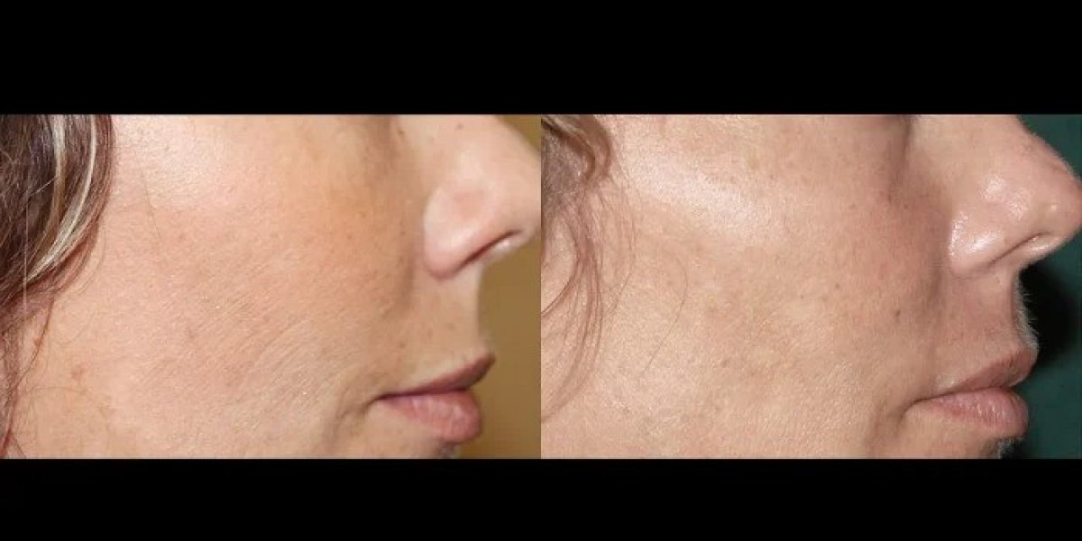 Best Doctors in Dubai for Fractional Radiofrequency (RF) Microneedling Treatment