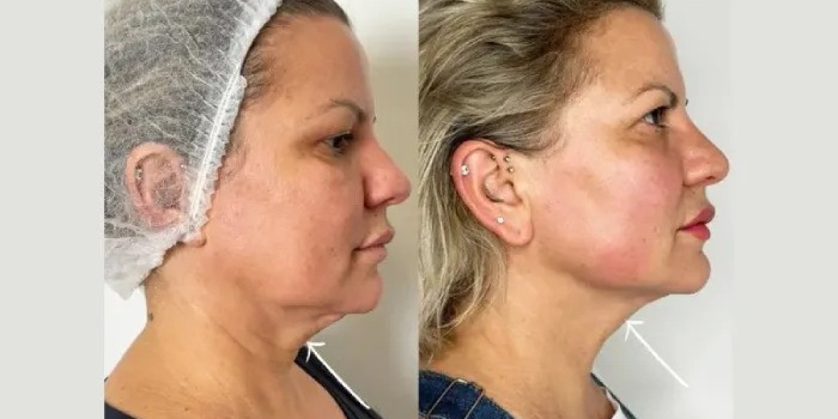 Endolift Treatments in Dubai for Facial Fat Reduction