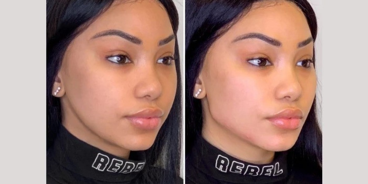 Thread Lift with Best Plastic Surgeons in Dubai Personalized Beauty Approach