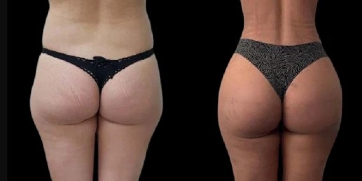 Best Doctors in Dubai for J-Plasma Skin Tightening Guide