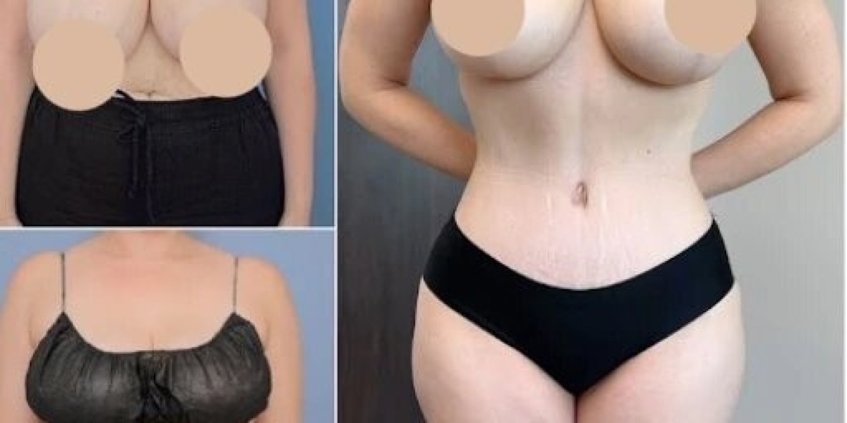 Best Doctors in Dubai for Tummy Tuck: Results That Look Natural and Last