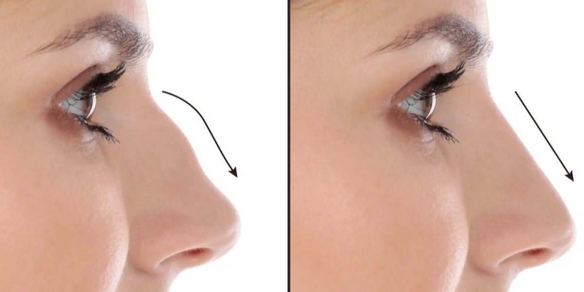 Why Choose Best Septoplasty Surgeons in Dubai for Airflow Care?