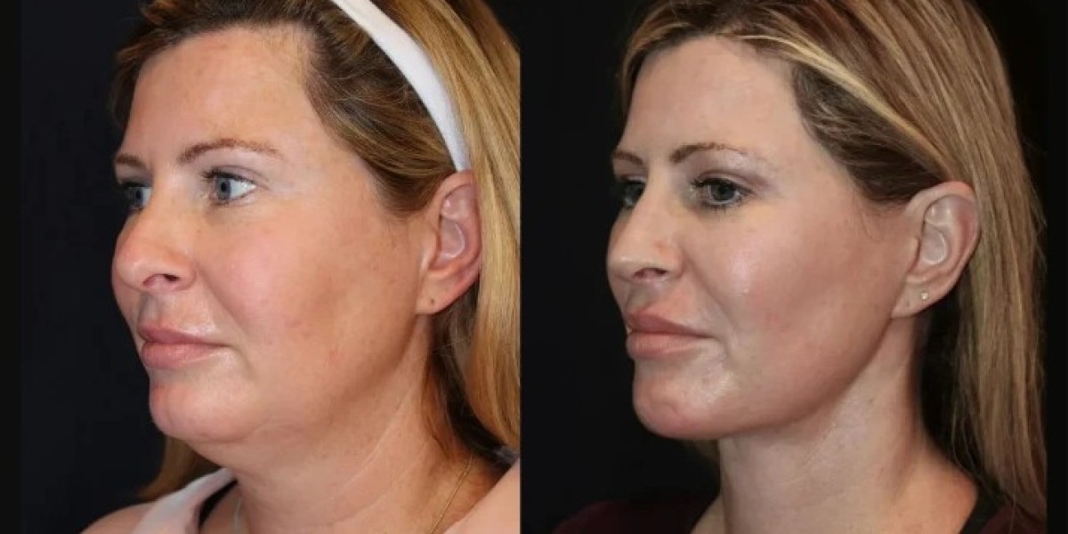 Best Doctors in Dubai for Ultimate Skin Tightening