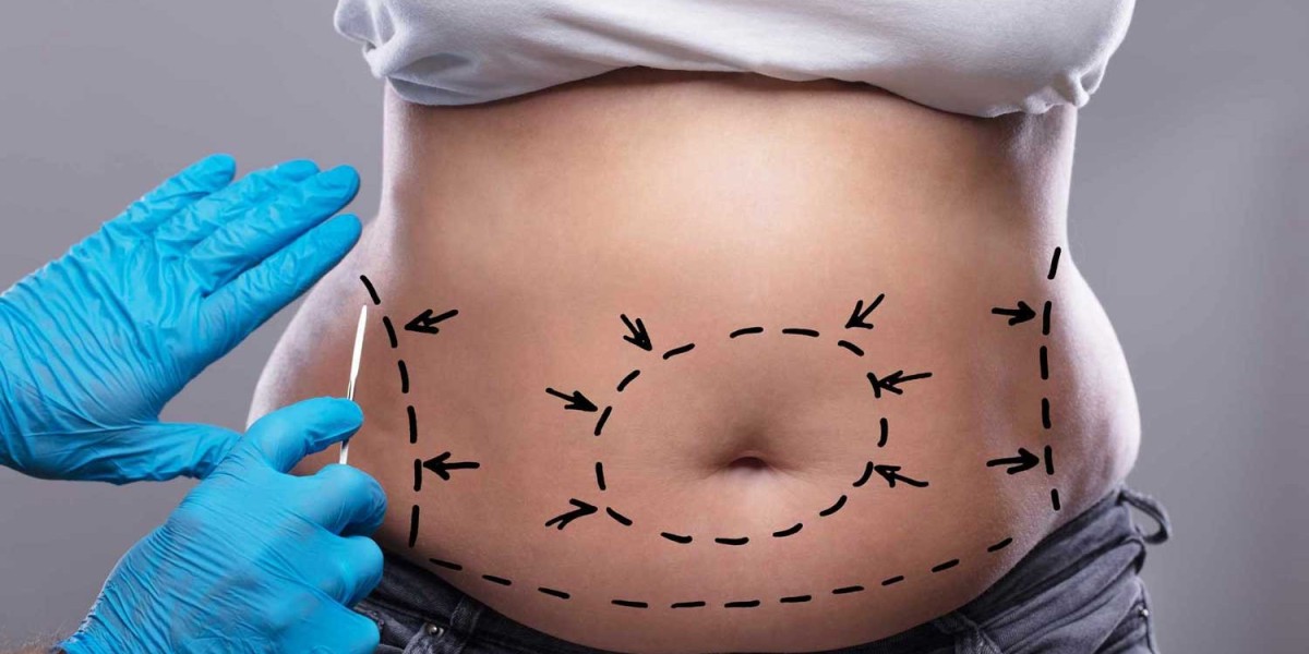 Complete Guide to Tummy Tuck Dubai Procedure, Recovery, and Results