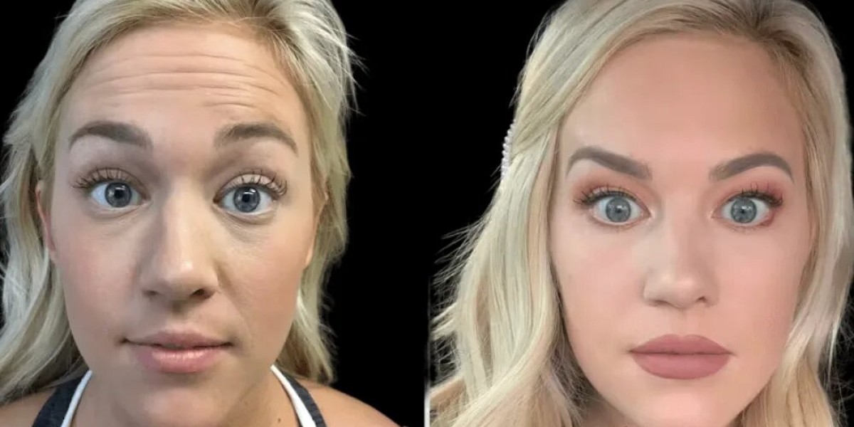 Best Plastic Surgeons in Dubai Talk About Combining Botox with Fillers