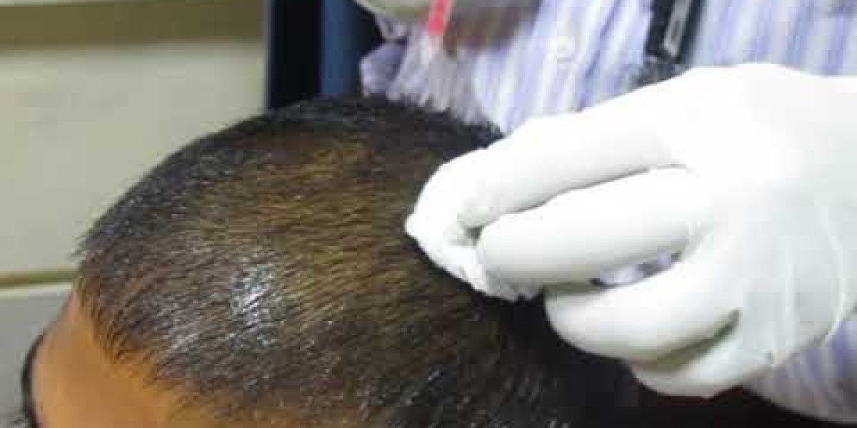 Effective Ways to Restore Hair Without Surgery or Pain