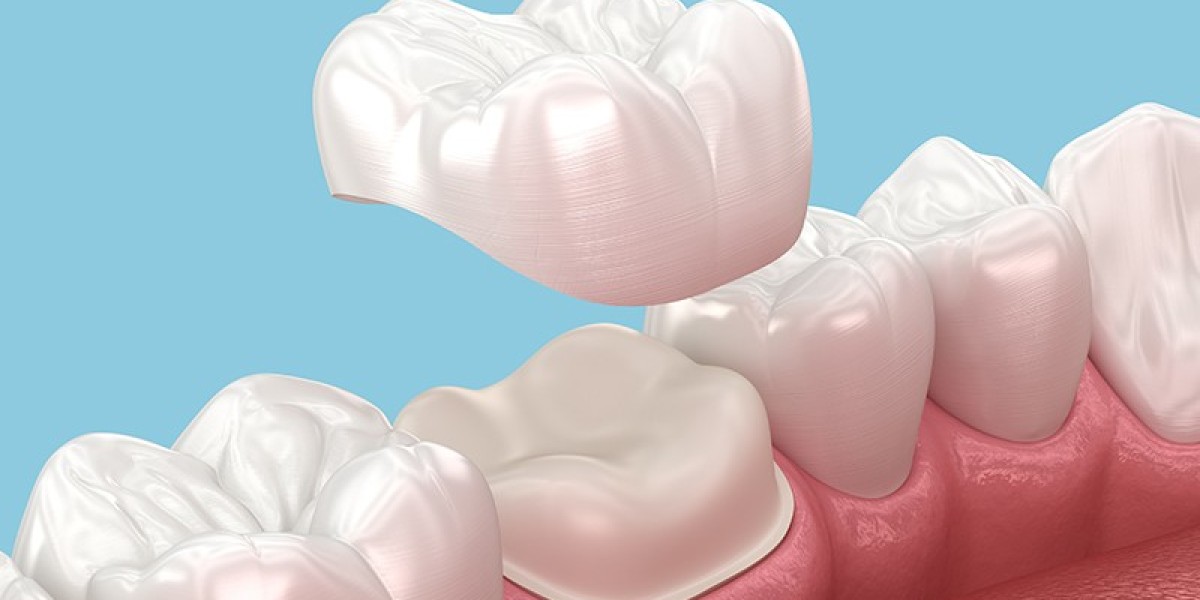 Dental Crowns and Bridges Dubai: Restore Your Teeth Strength