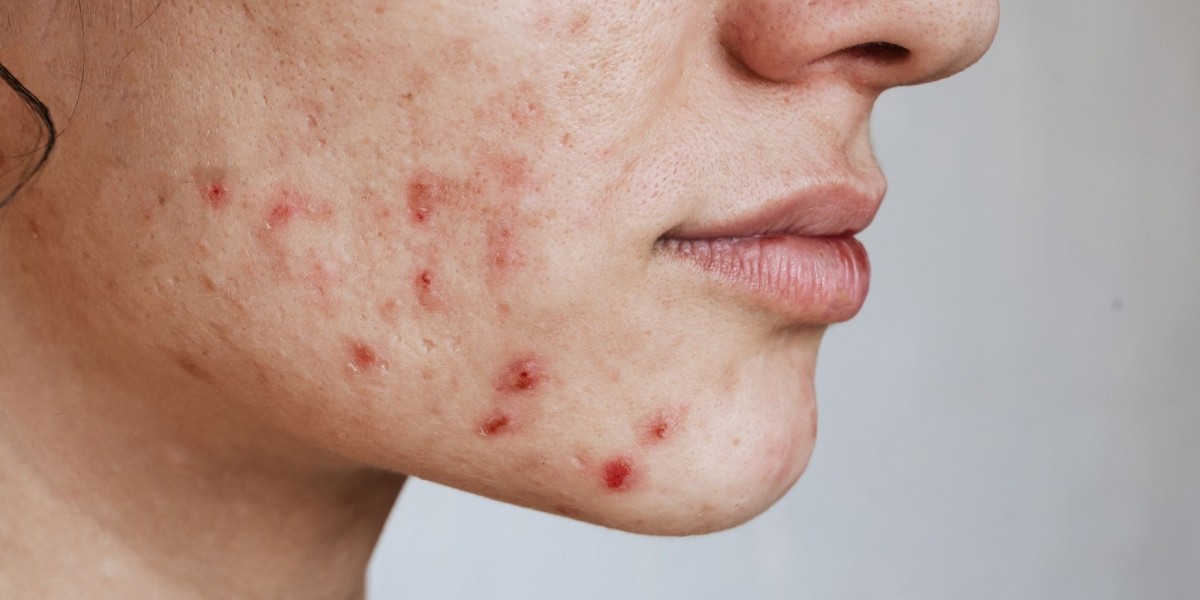 Acne Treatment in Dubai for Clear Skin and Long Lasting Confidence