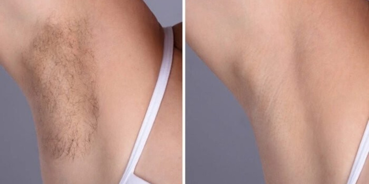 Best Aesthetic Clinic in dubai Electrolysis Laser Hair Removal Benefits