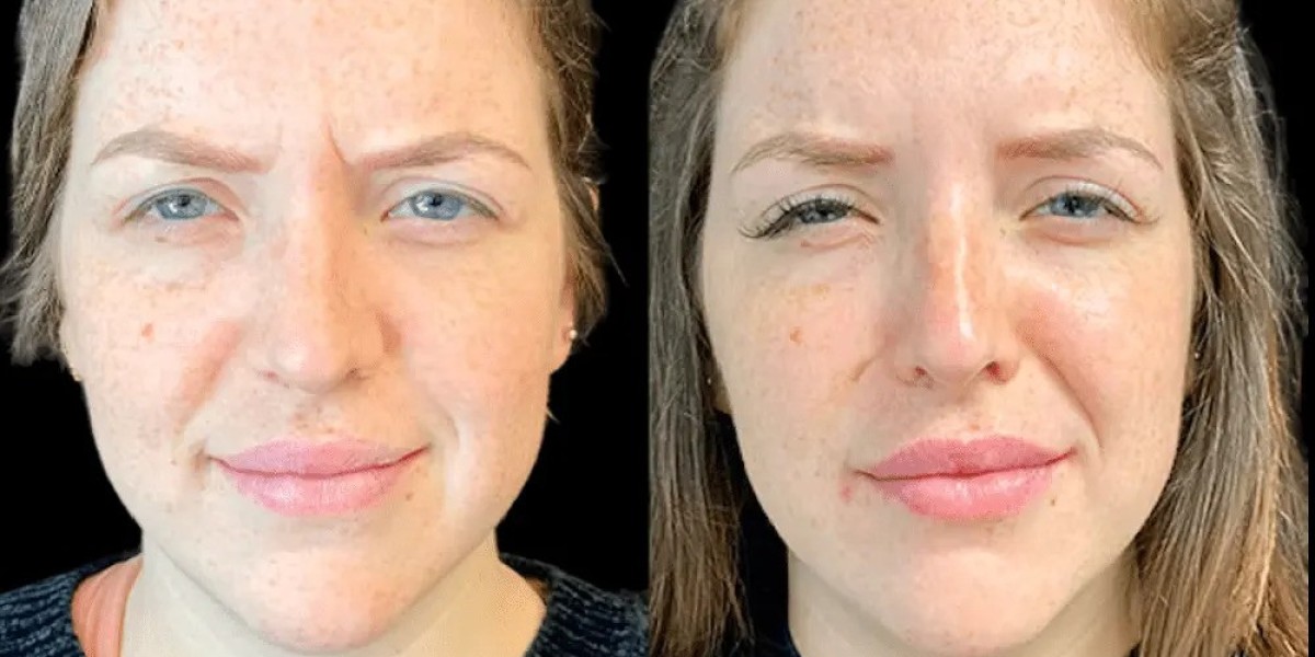 Before & After Botox Results from Best Aesthetic Clinics in Dubai