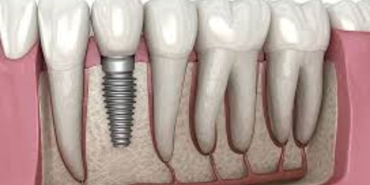 Ways To Choose The Perfect Dental Implant Provider