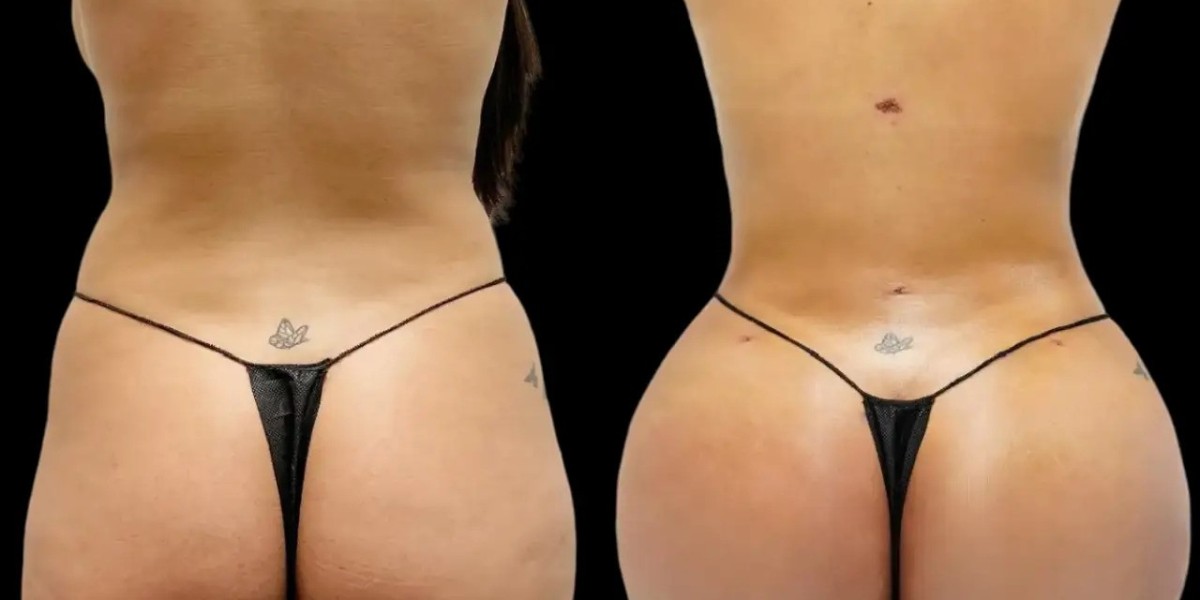 Fat transfer in Dubai for natural tissue enhancement