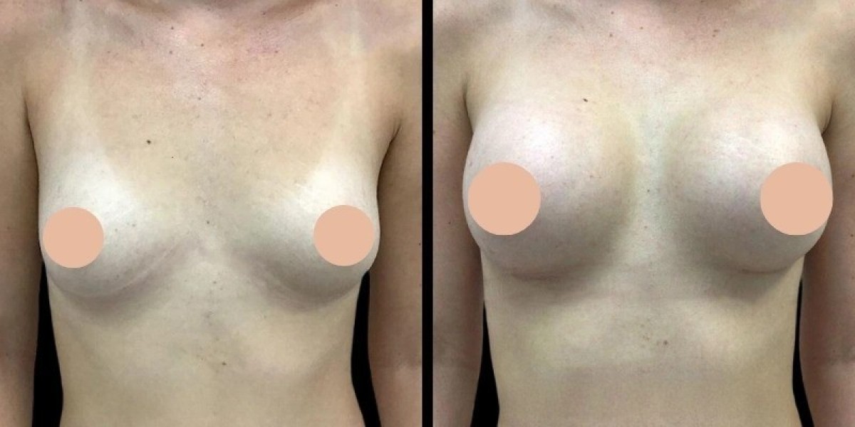 Best Breast Enhancement Surgeon in Dubai Advanced Techniques