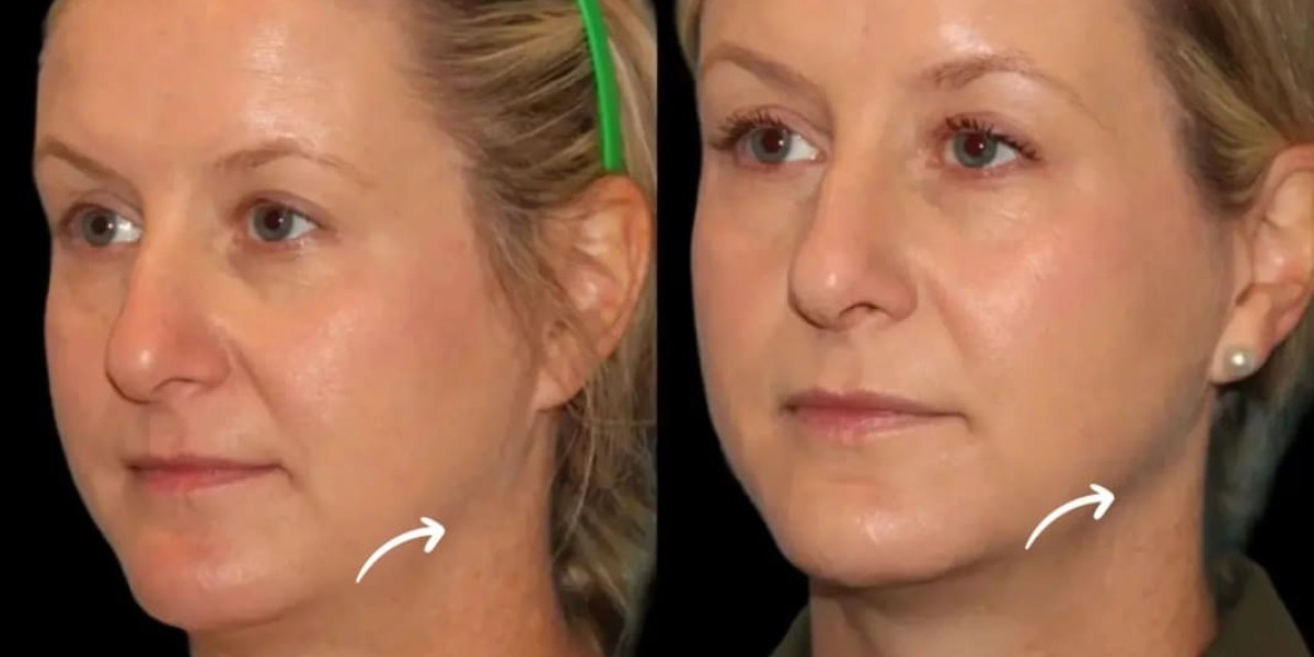 Sculptra Fillers in Dubai for Chin Wrinkles Treatment