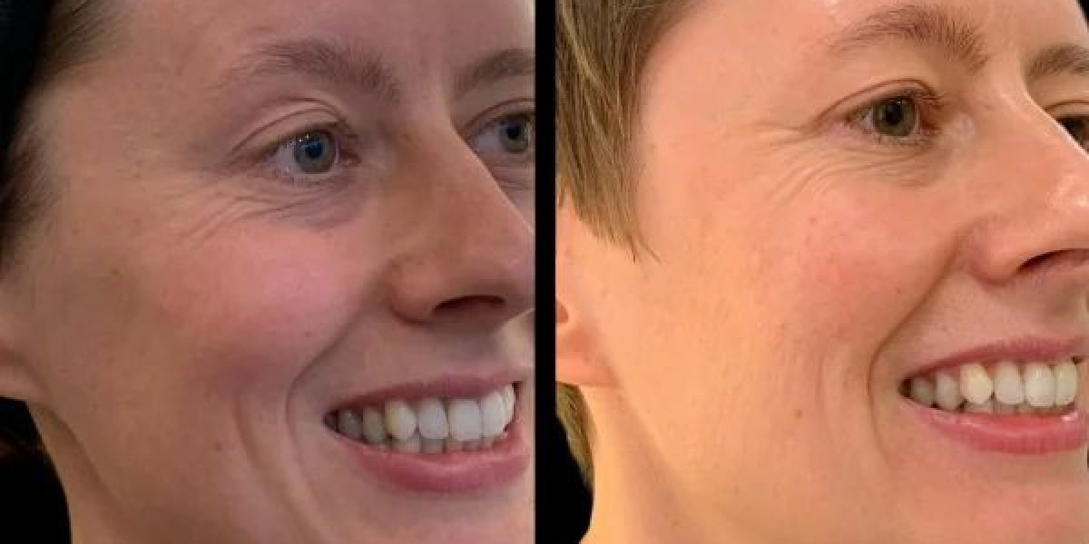 How Best Aesthetic Clinics in Dubai Use Profhilo for Skin Firmness