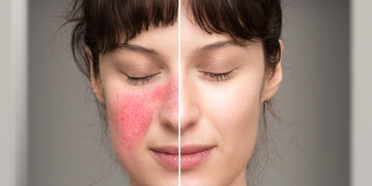 Rosacea in Manchester: Causes, Triggers, and Treatments